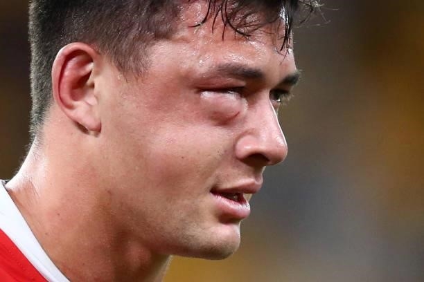 Joseph Manu of the Roosters is seen with a cheek injury after a tackle from Latrell Mitchell of the Rabbitohs during the round 24 NRL match between...